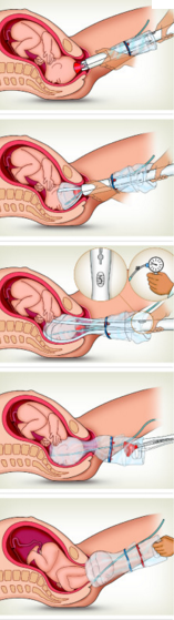 odon device