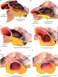 axial-craniocaudal-views-of-mesosigmoid-and-mesorectum_osteomag